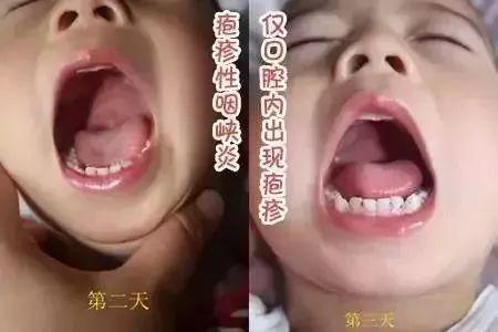 咽喉疱疹图片